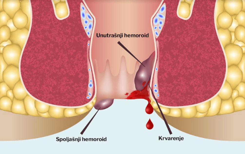 Hemoroidi – anatomija i prirodni pristup lečenju
